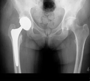 What is an Artificial Hip?